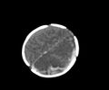Abusive head trauma (Radiopaedia 70205-80252 Axial non-contrast 25).jpg