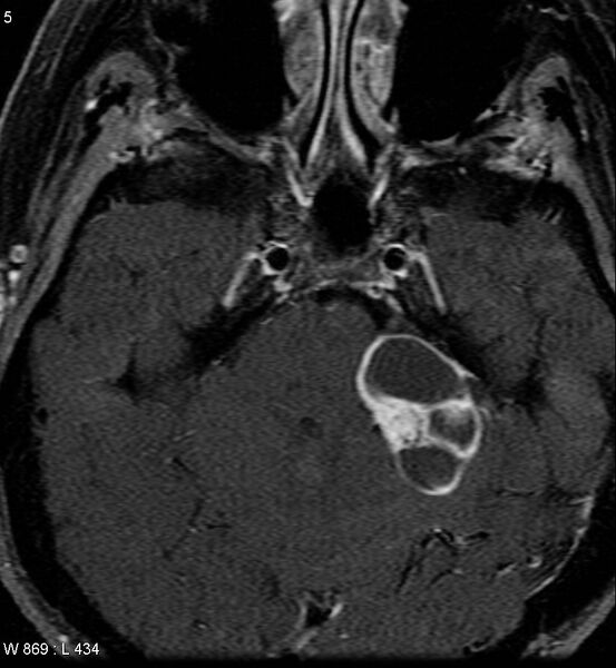 File:Acoustic schwannoma (large with cystic change) (Radiopaedia 5369-7130 Axial T1 C+ fat sat 3).jpg