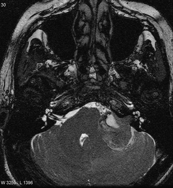 File:Acoustic schwannoma (large with cystic change) (Radiopaedia 5369-7130 Axial T2 3).jpg