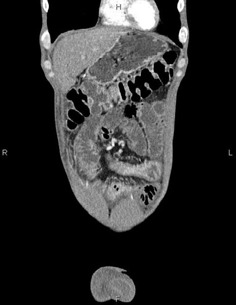 File:Active crohn disease (Radiopaedia 87133-103397 Coronal C+ arterial phase 8).jpg
