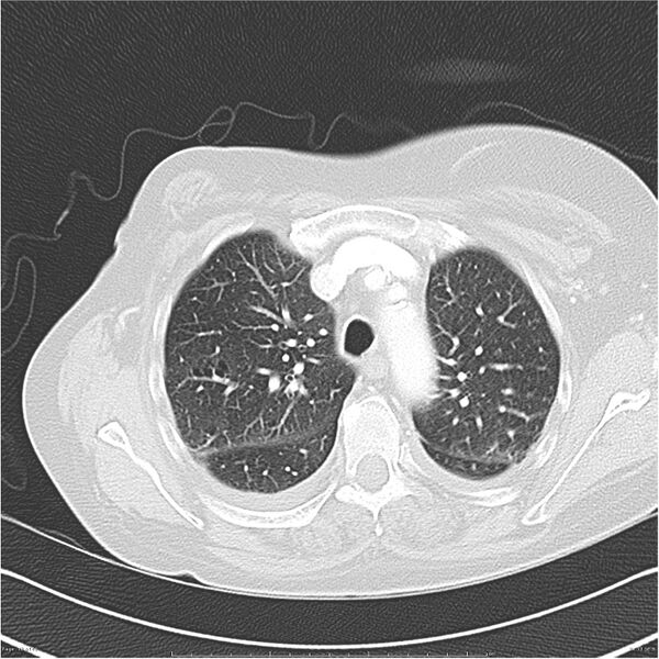 File:Acute-on-chronic pulmonary emboli (Radiopaedia 27925-28169 lung window 13).jpg