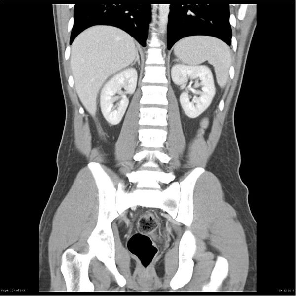 File:Acute appendicitis (Radiopaedia 25364-25615 C+ portal venous phase 21).jpg