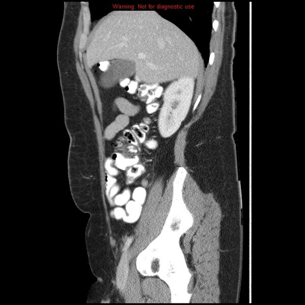 File:Acute appendicitis (Radiopaedia 7966-8812 B 8).jpg