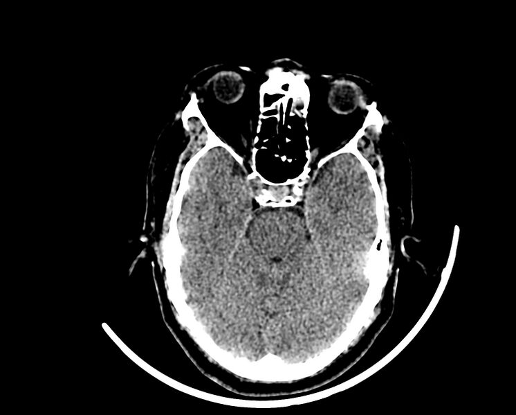 File:Acute cerebral infarct (Radiopaedia 35604-37123 Axial non-contrast 32).jpg