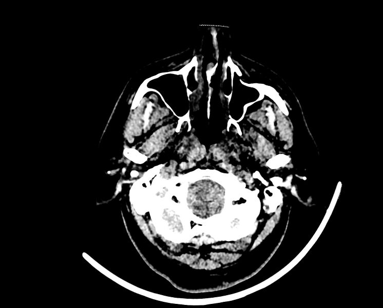 File:Acute cerebral infarct (Radiopaedia 35604-37123 Axial non-contrast 8).jpg