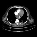 Acute heart failure (CT) (Radiopaedia 79835-93075 Axial C+ arterial phase 33).jpg