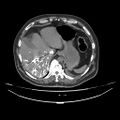 Acute heart failure (CT) (Radiopaedia 79835-93075 Axial C+ arterial phase 71).jpg