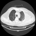 Acute heart failure (CT) (Radiopaedia 79835-93075 Axial lung window 13).png