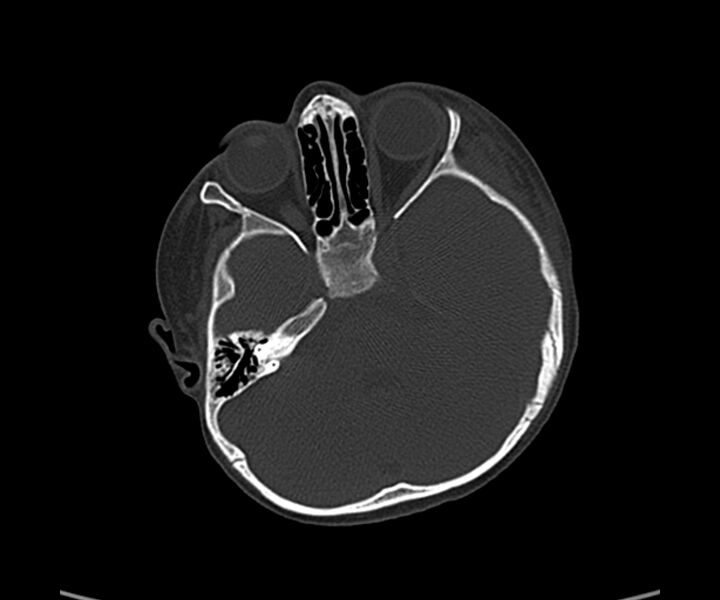 File:Acute hemorrhagic contusion (Radiopaedia 63660-72336 Axial bone window 20).jpg