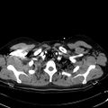 Acute myocardial infarction in CT (Radiopaedia 39947-42415 Axial C+ arterial phase 14).jpg