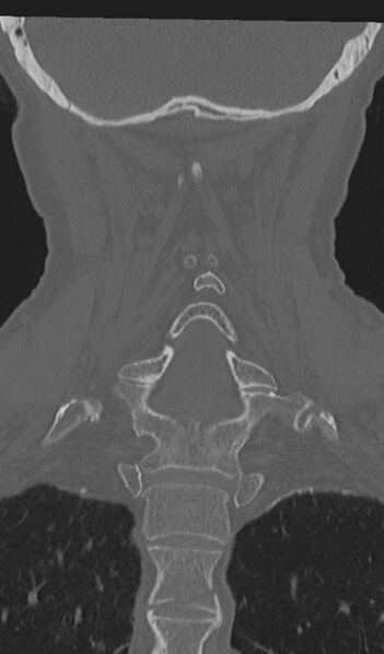 File:Acute on chronic subdural hematoma and thoracic vertebral injury in a multitrauma patient (Radiopaedia 31698-32619 Coronal bone window 43).jpg