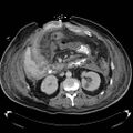 Acute pancreatic necrosis (Radiopaedia 13560-18503 Axial C+ portal venous phase 37).jpg