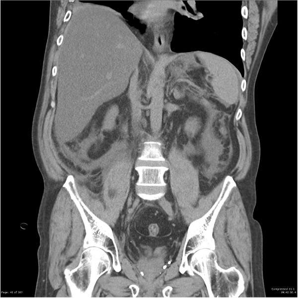 File:Acute pancreatitis (Radiopaedia 19135-19116 Coronal non-contrast 27).jpg