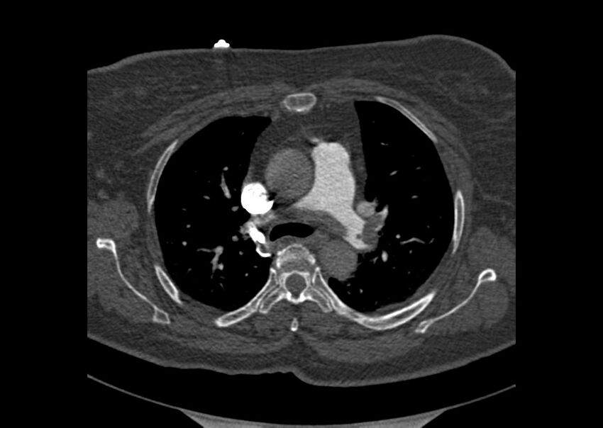 Acute pulmonary embolism (Radiopaedia 29938-30466 Axial C+ CTPA 34).jpg