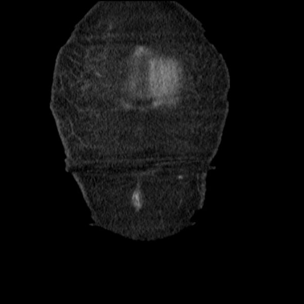 File:Acute tubular necrosis (Radiopaedia 28077-28334 G 9).jpg