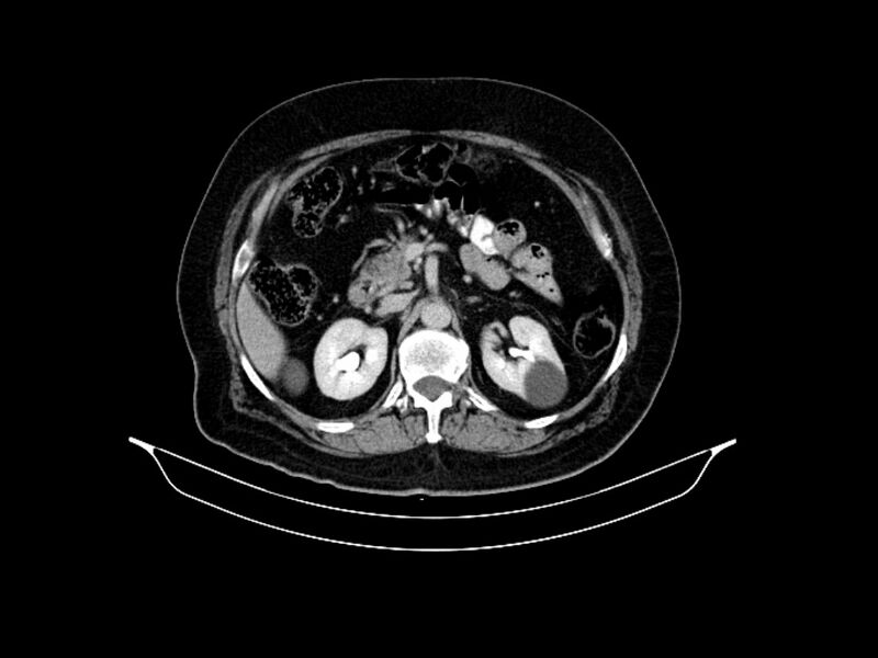 File:Adenocarcinoma of pancreas with hepatic metastasis (Radiopaedia 64332-73122 Axial C+ delayed 38).jpg