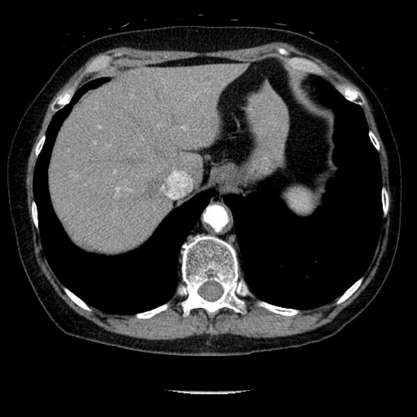 File:Adenocarcinoma of the lung (Radiopaedia 41015-43755 Axial C+ portal venous phase 107).jpg