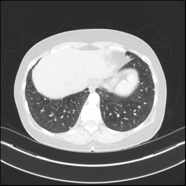 File:Adenocarcinoma of the lung (Radiopaedia 44205-47803 Axial lung window 74).jpg