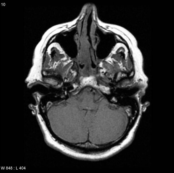 File:Adenoid cystic carcinoma (nasal septum) (Radiopaedia 4547-6668 Axial T1 1).jpg