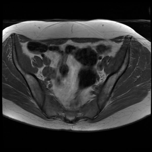 File:Adenoma malignum of the cervix (Radiopaedia 24460-24765 T1 6).jpg