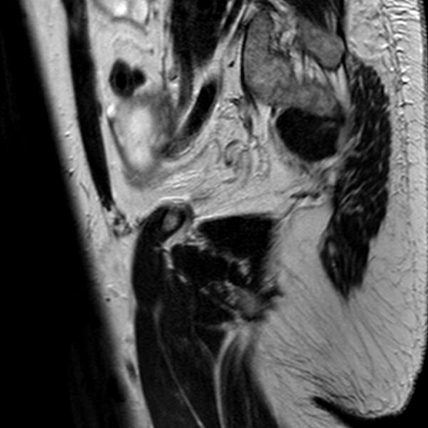 File:Adenomyoma of the uterus (Radiopaedia 9871-10439 Sagittal T2 5).jpg