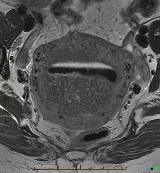 File:Adenomyosis uterus with hematometra (Radiopaedia 45779-50011 Axial T2 14).jpg