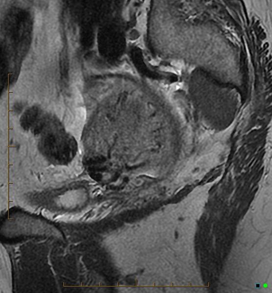 File:Adenomyosis uterus with hematometra (Radiopaedia 45779-50011 Sagittal T2 24).jpg