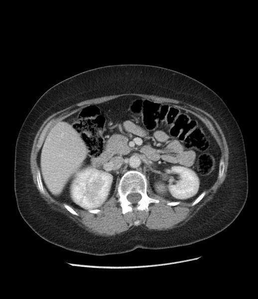 File:Adrenal cortical carcinoma with IVC invasion and thrombosis (Radiopaedia 34307-35597 Axial C+ portal venous phase 34).jpg