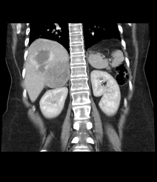 File:Adrenal cortical carcinoma with IVC invasion and thrombosis (Radiopaedia 34307-35597 Coronal C+ portal venous phase 35).jpg