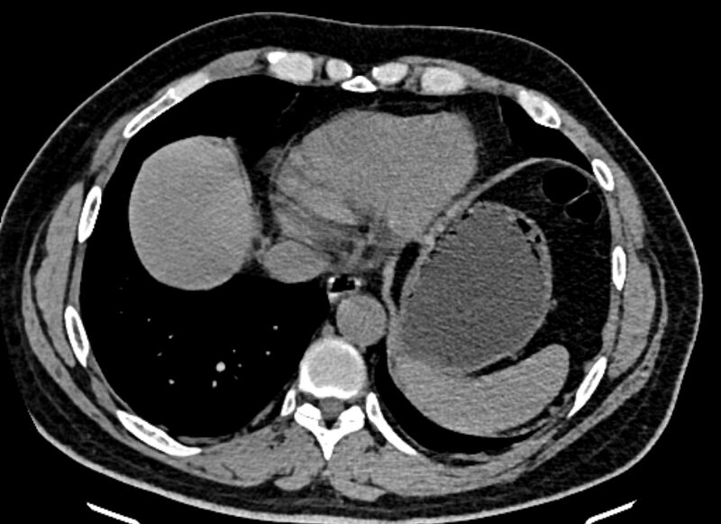 File:Adrenal metastases (Radiopaedia 73082-83791 Axial non-contrast 15).jpg