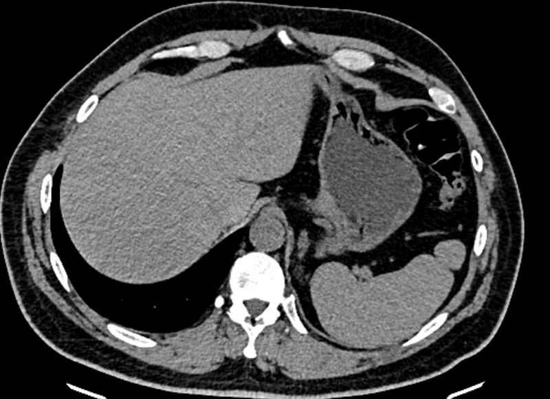 File:Adrenal metastases (Radiopaedia 73082-83791 Axial non-contrast 30).jpg