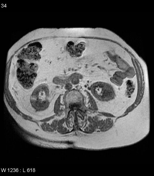 File:Adrenal myelolipoma (Radiopaedia 6765-7961 Axial T1 in-phase 34).jpg