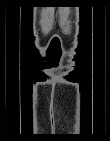 File:Adrenal myelolipoma - bilateral (Radiopaedia 74805-85810 Coronal C+ portal venous phase 29).jpg