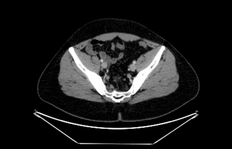 File:Adrenocortical carcinoma (Radiopaedia 80134-93438 Axial C+ portal venous phase 107).jpg