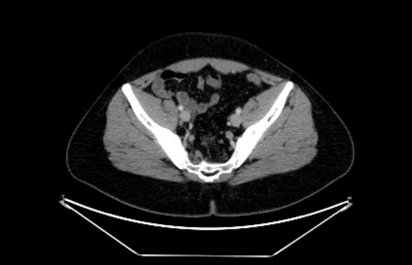 Adrenocortical carcinoma (Radiopaedia 80134-93438 Axial C+ portal venous phase 107).jpg