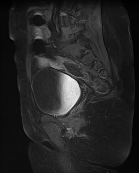 File:Adult granulosa cell tumor of the ovary (Radiopaedia 71581-81950 Sagittal T1 C+ fat sat 9).jpg