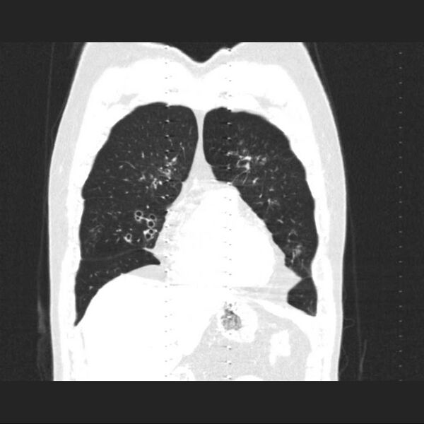 File:Allergic bronchopulmonary aspergillosis (Radiopaedia 21386-21320 Coronal lung window 4).jpg