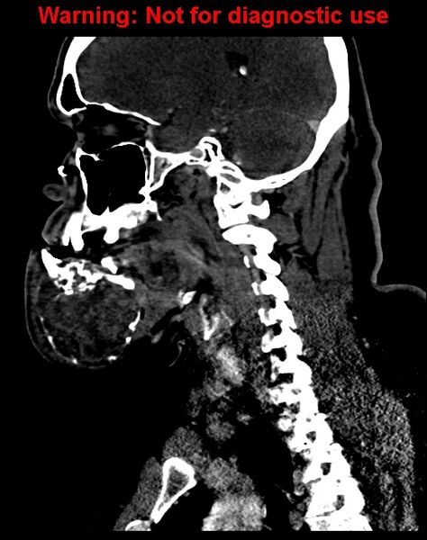 File:Ameloblastoma (Radiopaedia 33126-34164 F 43).jpg