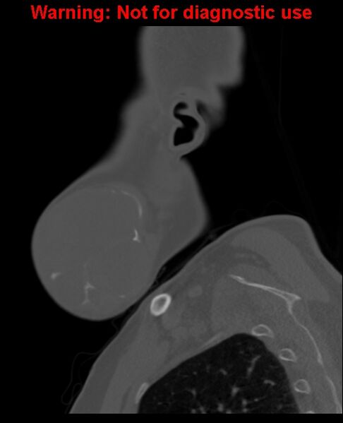 File:Ameloblastoma (Radiopaedia 33126-34164 Sagittal bone window 14).jpg