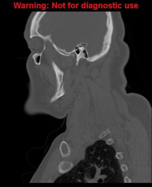 File:Ameloblastoma (Radiopaedia 33126-34164 Sagittal bone window 55).jpg