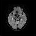 Amnestic syndrome secondary to hypoxic brain injury (Radiopaedia 24743-25004 DWI 13).jpg