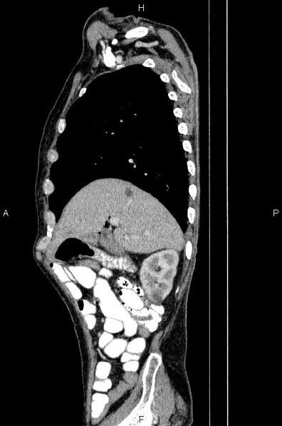 File:Ampullary adenocarcinoma (Radiopaedia 86093-102033 E 22).jpg
