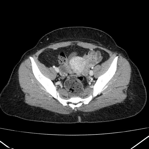 File:Ampullary tumor (Radiopaedia 22787-22816 C 57).jpg