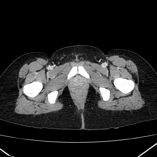 File:Ampullary tumor (Radiopaedia 22787-22816 C 73).jpg