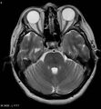 Amyotrophic lateral sclerosis (Radiopaedia 5373-7134 Axial T2 8).jpg