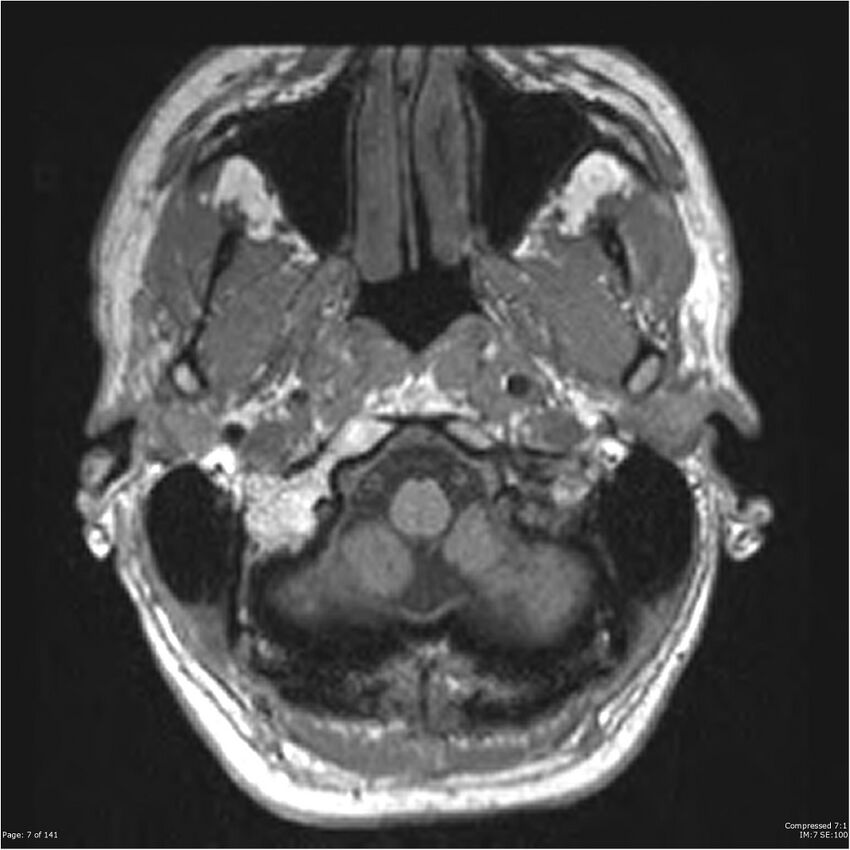 Anaplastic meningioma with recurrence (Radiopaedia 34452-35788 Axial T1 5).jpg