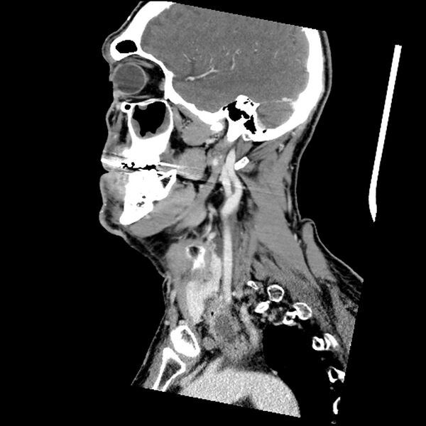 File:Anaplastic thyroid carcinoma (Radiopaedia 79087-92034 C 65).jpg