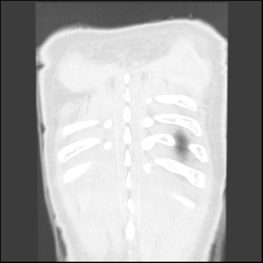 Angioinvasive aspergillosis (Radiopaedia 43957-47466 Coronal lung window 1).jpg