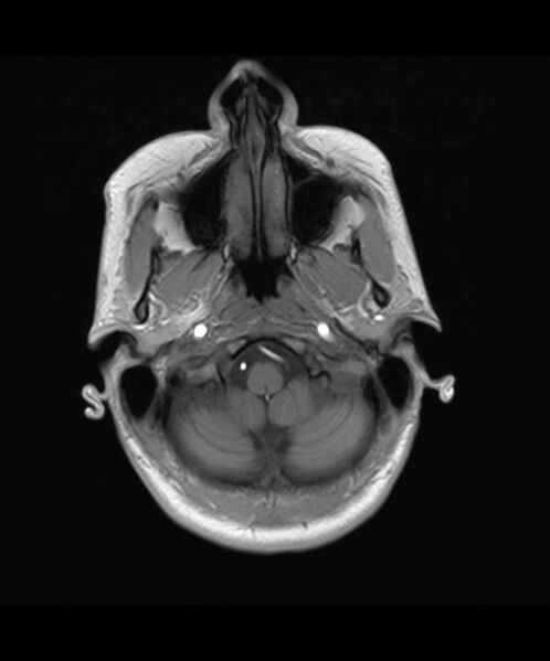 File:Angiomatous meningioma (Radiopaedia 79459-92579 Axial T1 2).jpg