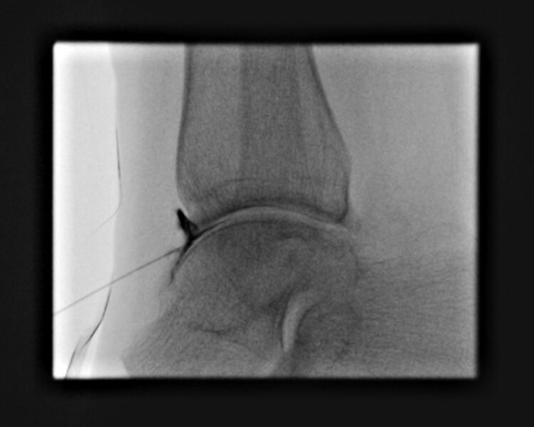 File:Ankle joint injection (fluoroscopic guided) (Radiopaedia 87288-103578 Lateral 15).jpg